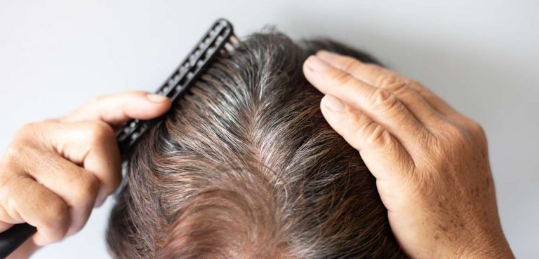 finasteride contro la caduta dei capelli