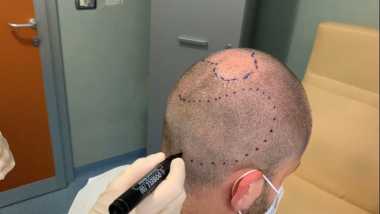 Trapianto capelli FUE in Italia - fase 5 preparazione del paziente