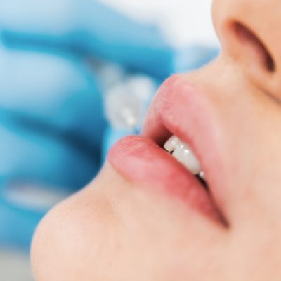 Filler con acido ialuronico
