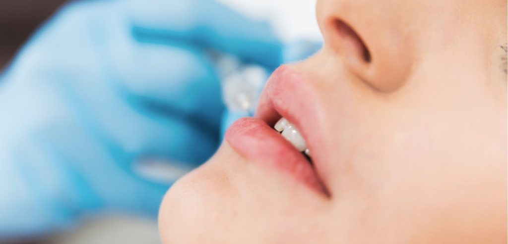 Medico con guanti che prepara una siringa di acido ialuronico per il filler